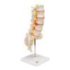 Lannerankamalli - Human Lumbar Spinal Column Model with Dorso-Lateral Prolapsed Intervertebral Disc - 3B Smart Anatomy - Image 8