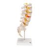 Lannerankamalli - Human Lumbar Spinal Column Model with Dorso-Lateral Prolapsed Intervertebral Disc - 3B Smart Anatomy - Image 7