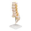 Lannerankamalli - Human Lumbar Spinal Column Model with Dorso-Lateral Prolapsed Intervertebral Disc - 3B Smart Anatomy - Image 5