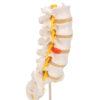 Lannerankamalli - Human Lumbar Spinal Column Model with Dorso-Lateral Prolapsed Intervertebral Disc - 3B Smart Anatomy - Image 4