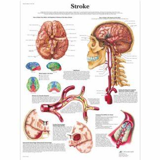 Aivohalvaus kartta VR1627L_01_Stroke-Chart